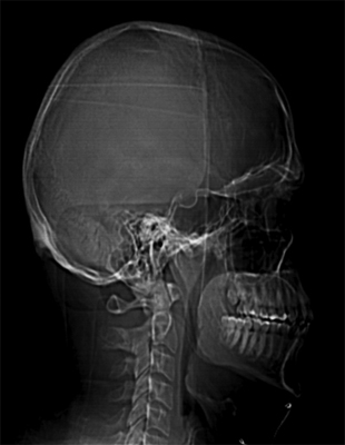 My head seen on a CT scan. ©2012 Max Gersh